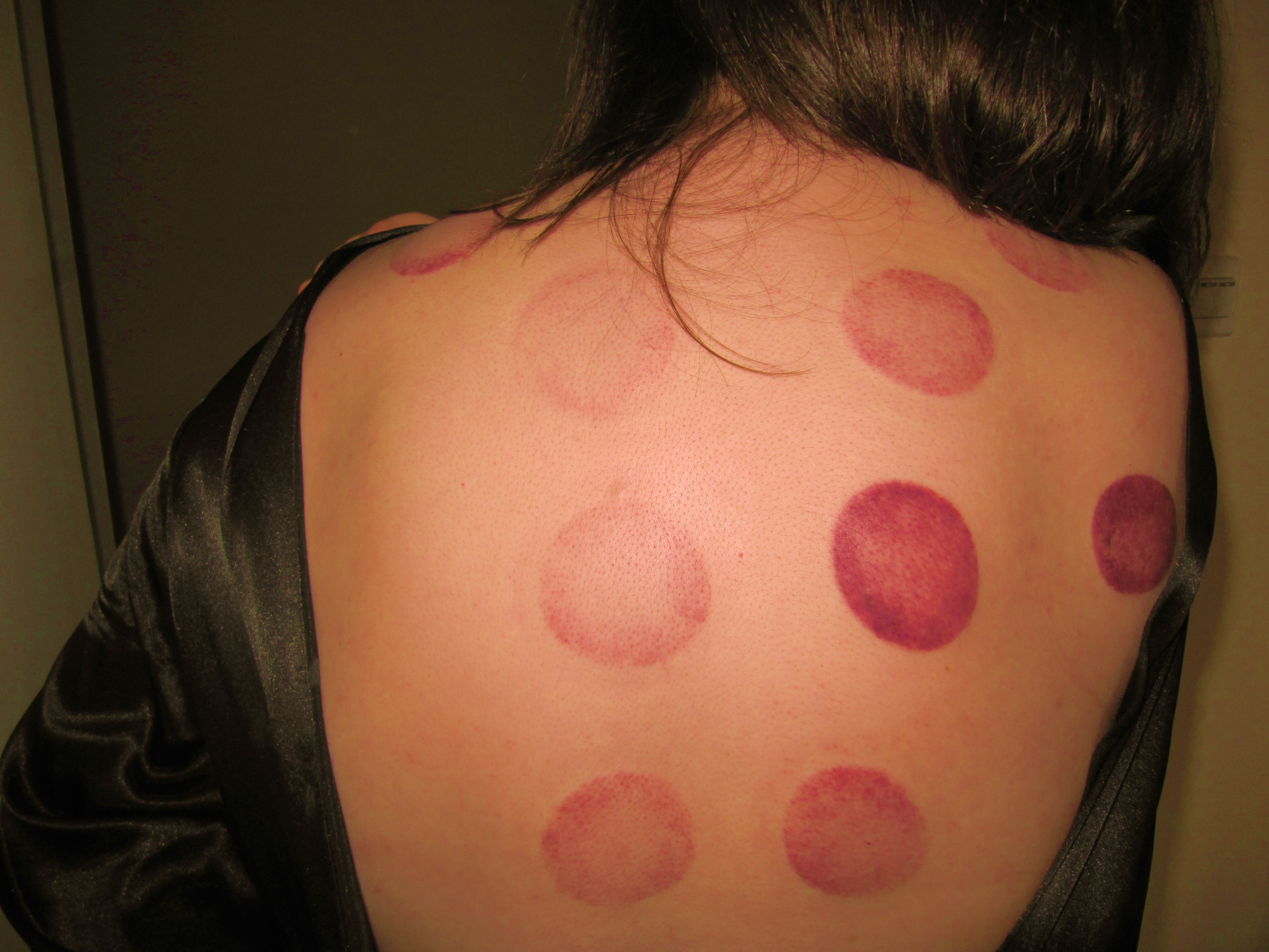 Red Blotchy Skin on the Neck | LIVESTRONG.COM